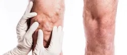 Dr.Abhinav Kesarwani-Varicose Vein Speci